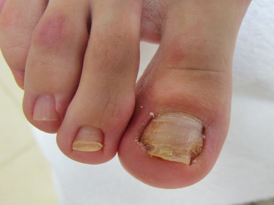 toenail fungus symptoms