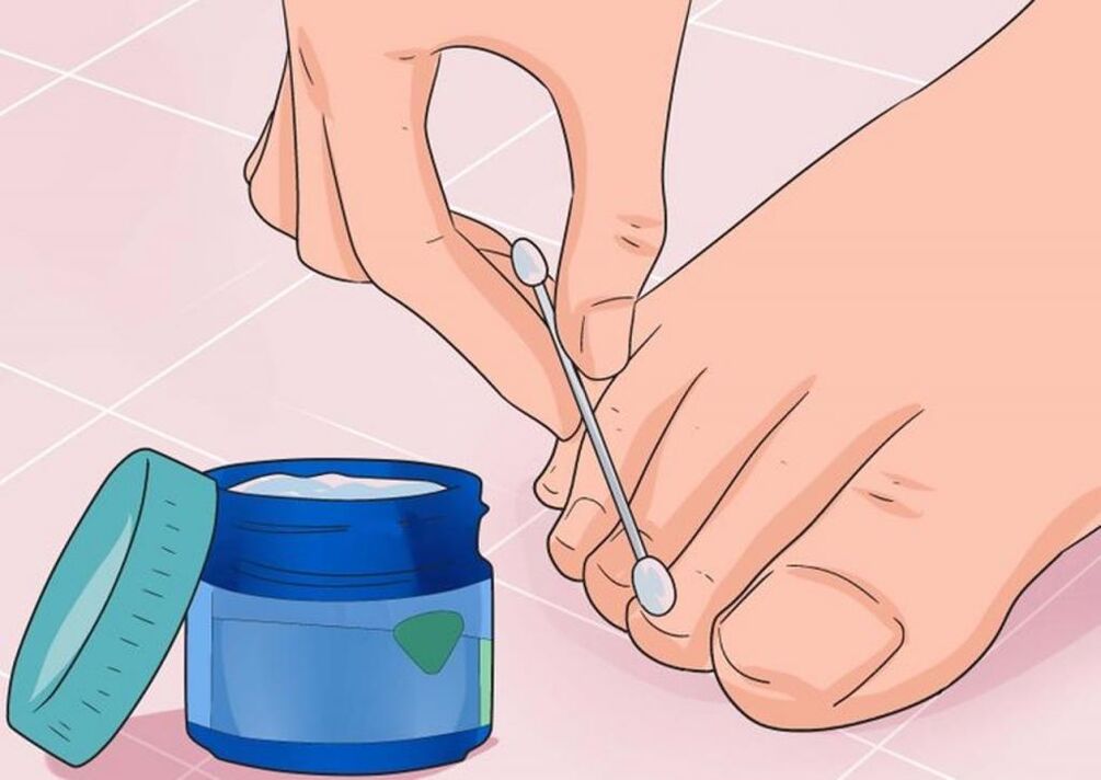application of ointment to treat nail fungus