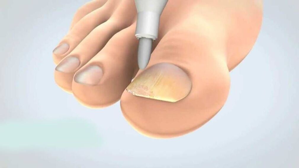 treatment of toenail fungus