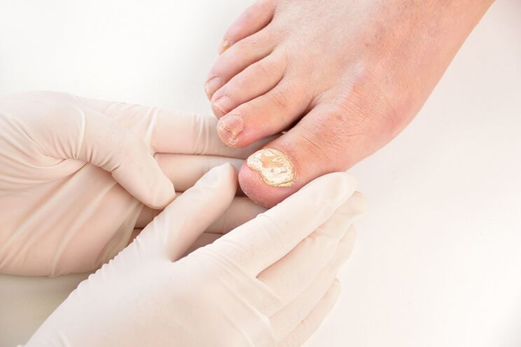 Before prescribing treatment, the doctor must diagnose toenail fungus