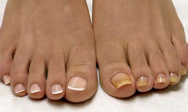 Healthy toenails (left) and affected by fungus (right)