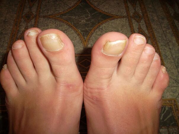 Thickening of the toenails in onychomycosis