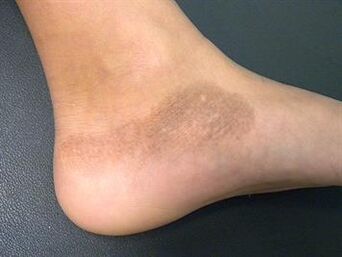 Mycosis of the feet is accompanied by a change in skin tone