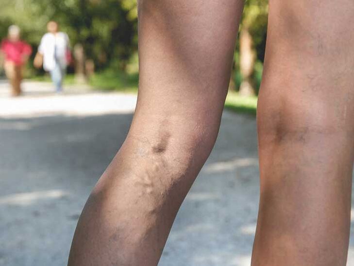 Varicose veins are a risk factor for athlete's foot infection