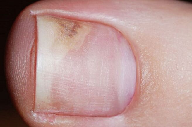 Signs of onychomycosis in the initial stage - lack of shine, a gap between the nail and the bed