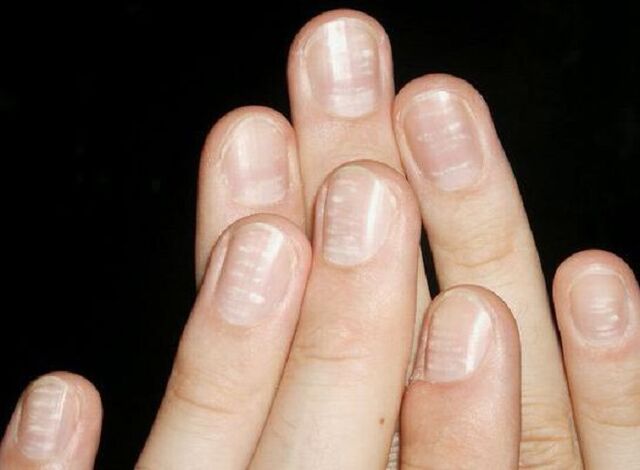 White spots on the nails are a sign of the development of fungus