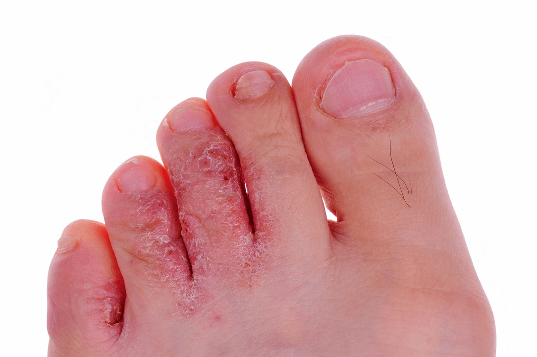 a fungal infection of the skin between the toes