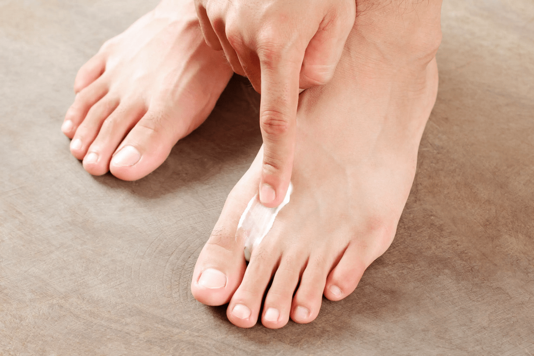 applying an antifungal ointment to the skin of the feet