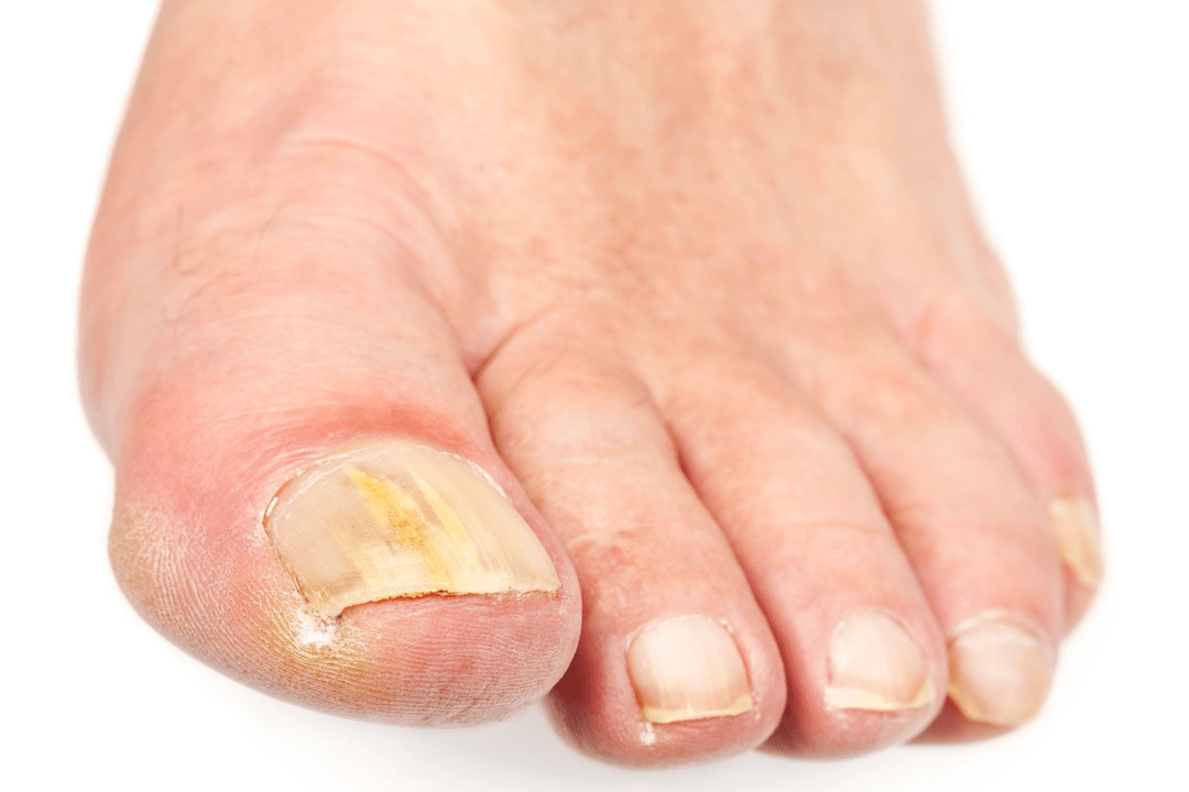 fungal infection of the nail plates