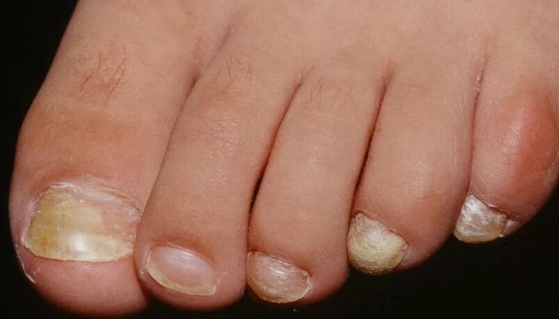 The fungus of the nails of the thumb