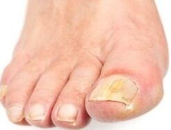 After the bathroom affected nail is easier to remove