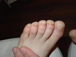 Nail fungus occurs even in children