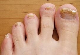 Onychomycosis