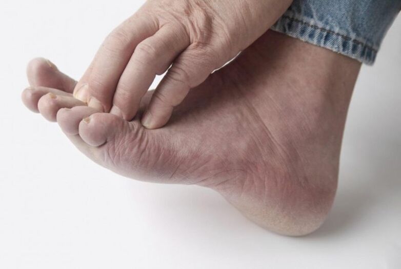 Leg fungus