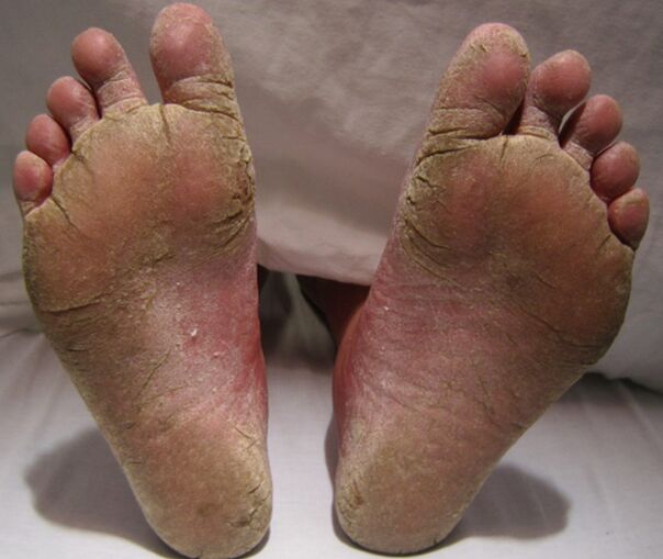 Mycotic lesion