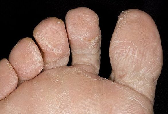 Types of fungus on the legs