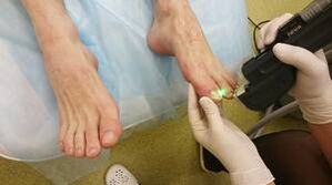 Hardware treatment of fungi