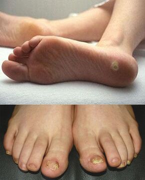 The fungus of the feet