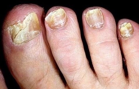 Nails are collapsed by the fungus