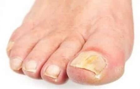 The initial stage of the fungus of the foot of the foot