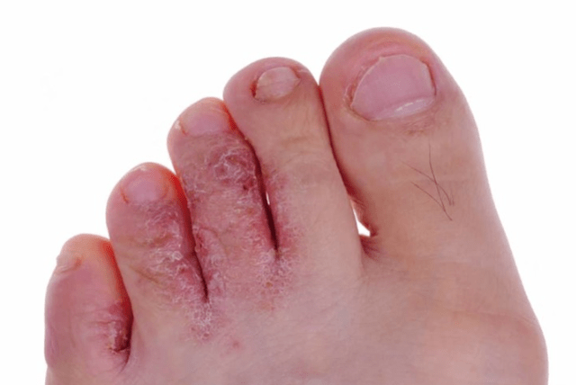 The advanced stage of mycosis
