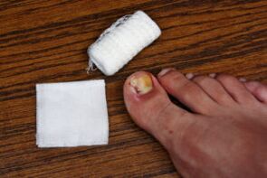 Compress with apple cider vinegar to treat fungi