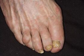 Treatment of nail fungus apple cider vinegar