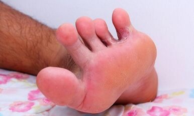 The reasons for the fungus between the toes