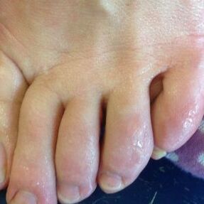 ways of fungal infection
