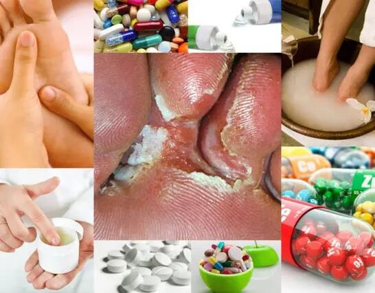 Interdigital mycosis and methods of treatment