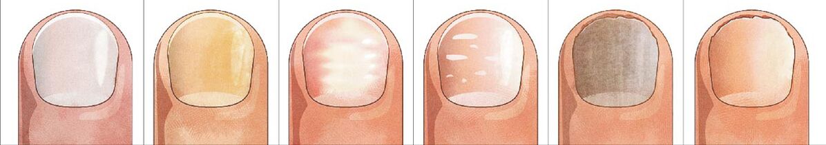How does nail fungus develop