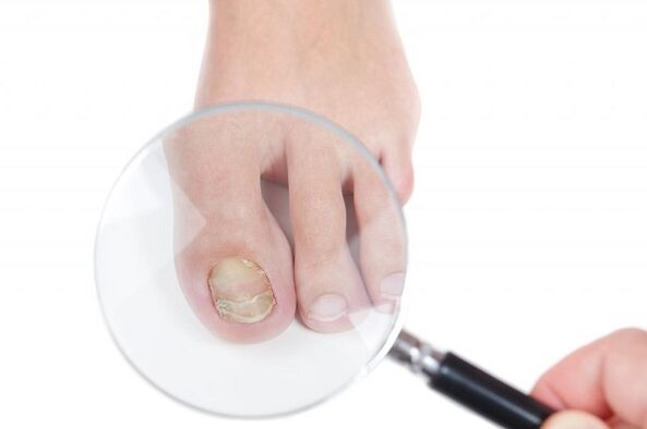 stages and stages of development of toenail fungus