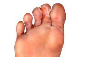 fungus between the fingers