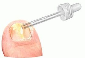 Applying medicinal drops to the nail affected by fungus