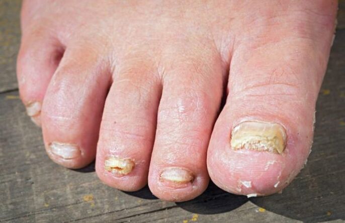 Rubromycosis fungi on the legs