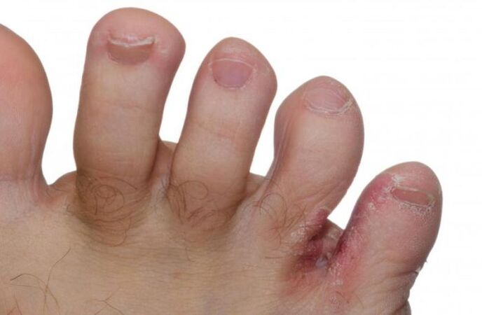 foot fungus between the toes