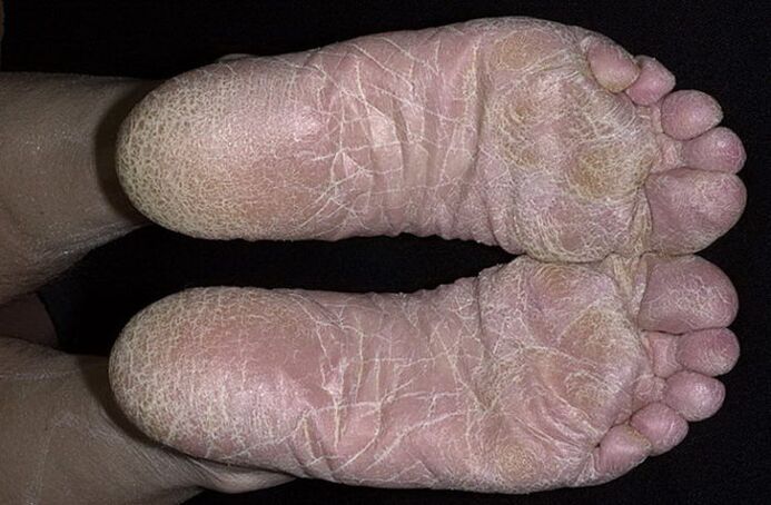 foot fungus