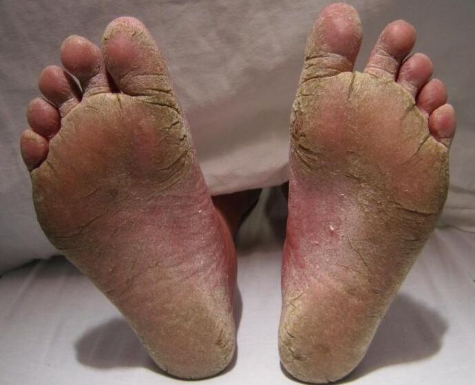 squamous-hyperkeratotic fungus on the legs
