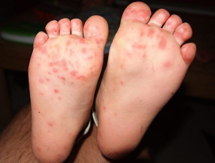 vesicular fungus on the legs