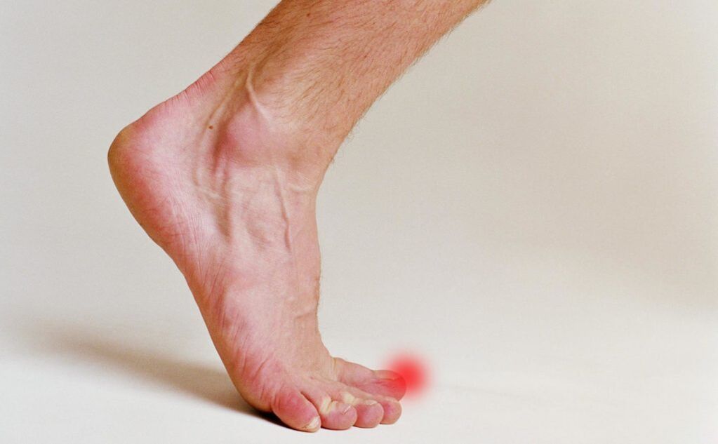 Fungus on the nails of the big toe