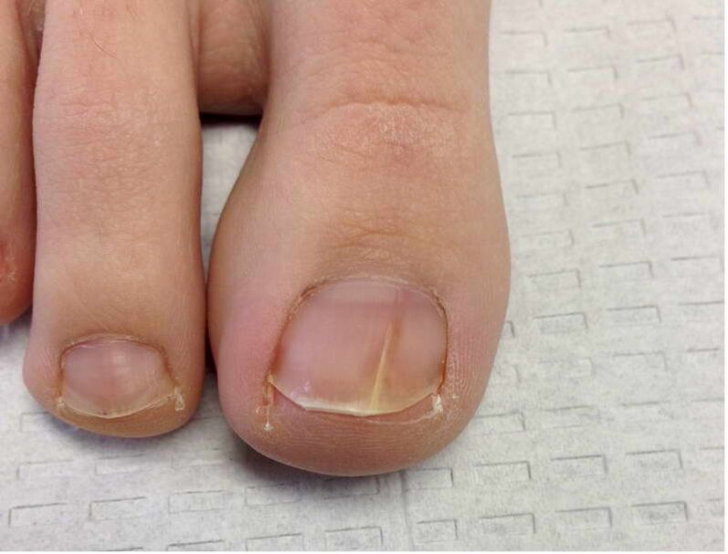 Streaks and spots on the nail of the big toe during the first stage of the development of the fungus