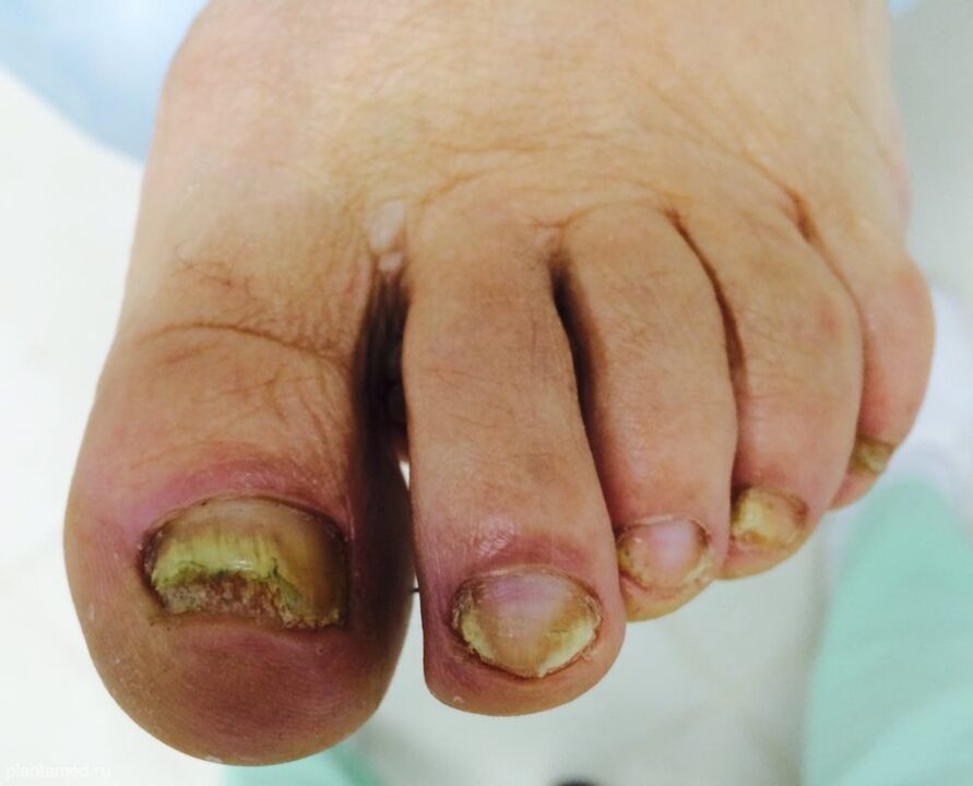 Strong deformation of the toenails is a sign of the third advanced stage of the fungus