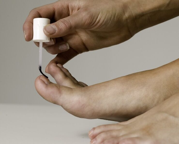 The use of medicinal varnish for the treatment and prevention of onychomycosis of the big toe