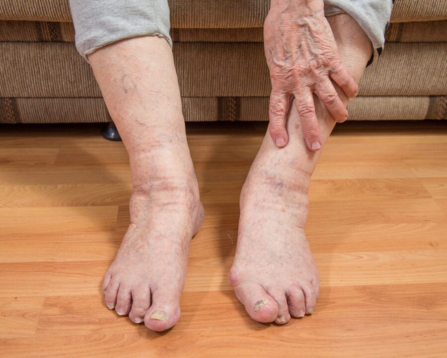 To avoid the spread of fungal microsporia, do not walk barefoot at home.