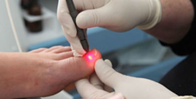 Laser treatment of nail fungus