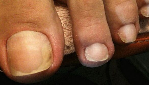 Signs of an early stage of toenail fungus